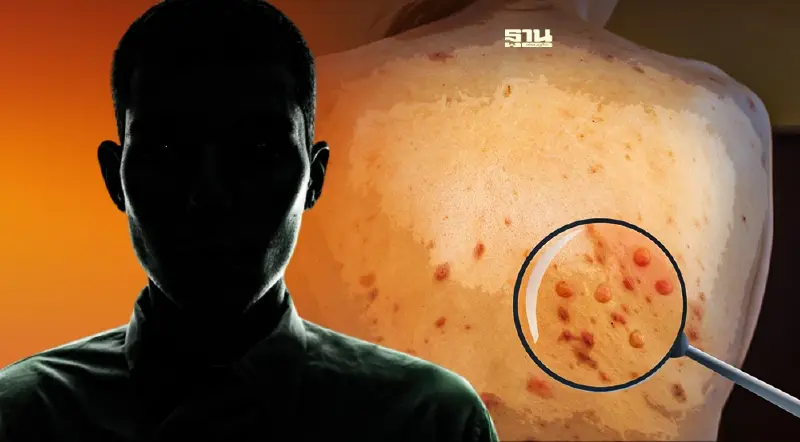 ไทยพบผู้ป่วยฝีดาษลิงรายที่ 12 เป็นชาวโอมาน เที่ยวสถานบันเทิง พักภูเก็ต