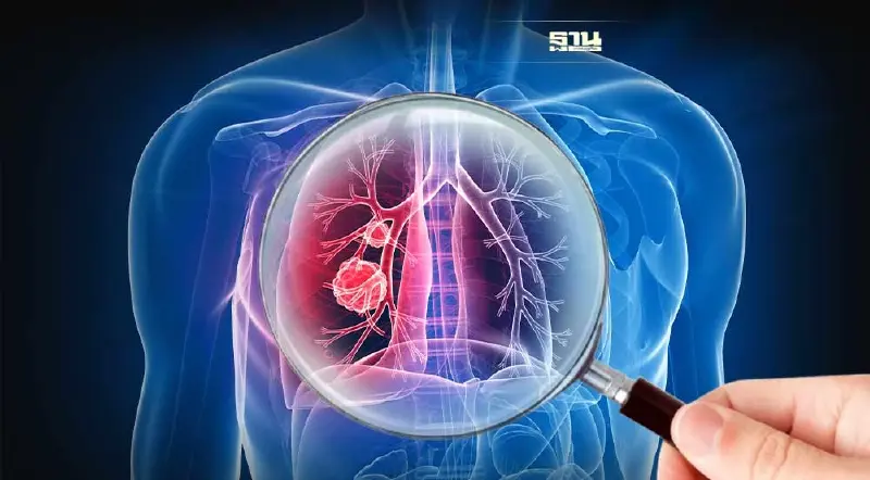 รู้จัก"มะเร็งปอด"โรคร้ายที่คร่าชีวิต"ครูมืด"บรมครูโขน สัญญานเตือน-อาการ