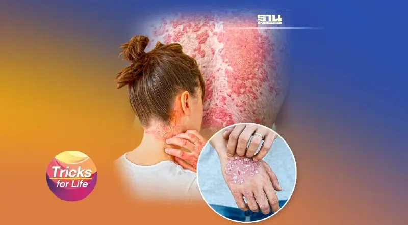 ‘สะเก็ดเงิน’  โรคเรื้อรัง รักษาได้ ไม่ต้องรังเกียจ