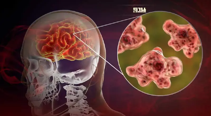 ทำความรู้จัก 'โรคสมองอักเสบจากเชื้ออะมีบา' อันตราย! แต่ไม่ติดต่อ ทำความรู้จัก 'โรคสมองอักเสบจากเชื้ออะมีบา' อันตราย! แต่ไม่ติดต่อ
