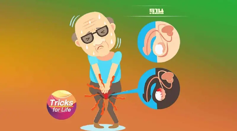 ‘มะเร็งต่อมลูกหมาก’ ภัยเงียบที่คุณผู้ชาย ไม่ควรมองข้าม