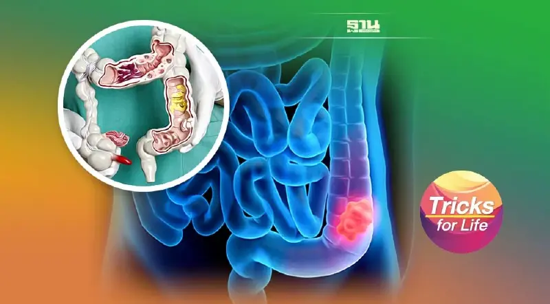 สัญญาณเตือน ‘มะเร็งลำไส้ใหญ่และไส้ตรง’
