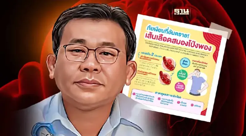 เตือน!เส้นเลือดสมองโป่งพองภัยเงียบอันตราย น่ากลัวอย่างไร เช็คเลย เตือน!เส้นเลือดสมองโป่งพองภัยเงียบอันตราย น่ากลัวอย่างไร เช็คเลย