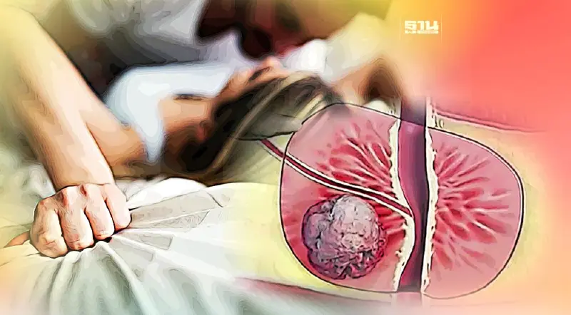 ผลวิจัยชี้มีเพศสัมพันธ์ 21 ครั้ง/เดือน ลดเสี่ยงมะเร็งต่อมลูกหมาก 20%