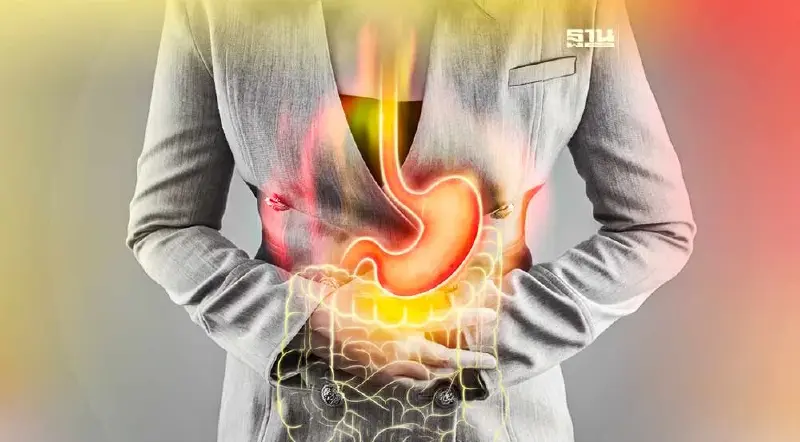 "กรดไหลย้อน"โรคใกล้ตัว รักษาได้แค่ปรับพฤติกรรม "กรดไหลย้อน"โรคใกล้ตัว รักษาได้แค่ปรับพฤติกรรม