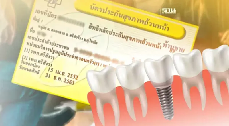 วิธีใช้สิทธิบัตรทอง บัตร 30 บาท ฝังรากฟันเทียม - ฟันปลอม วิธีใช้สิทธิบัตรทอง บัตร 30 บาท ฝังรากฟันเทียม - ฟันปลอม