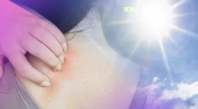 แพ้อากาศ "หน้าร้อน" เกิดอาการผดร้อนต้องทำอย่างไรเช็คเลยที่นี่