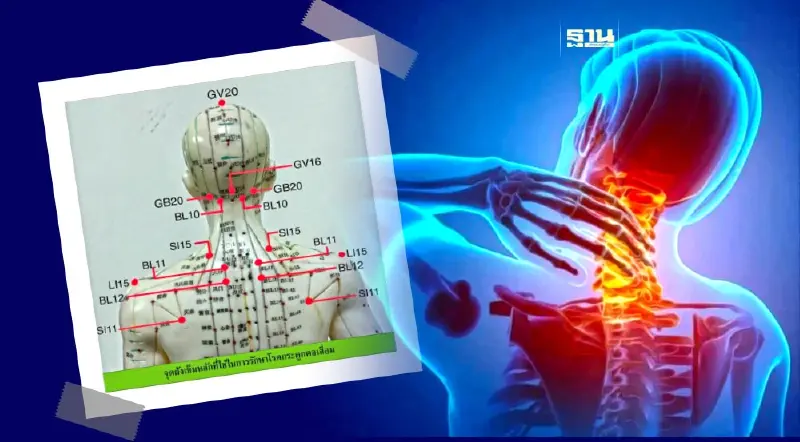 ผลวิจัยฝังเข็มร่วมนวดทุยหนา ลดความปวดโรคกระดูกคอเสื่อม