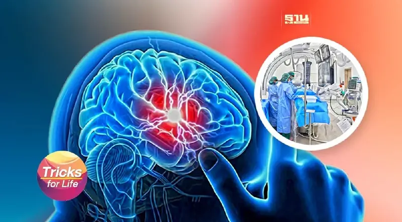 เช็คอัพ อาการเสี่ยง “โรคหลอดเลือดสมองโป่งพองแตก”