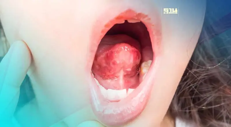 ระวัง! แผลในปากเรื้อรัง ที่ไม่ใช่ร้อนใน อาจเป็น"มะเร็งช่องปาก"