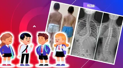 เตือน!เด็กนักเรียนแบกกระเป๋าหนักเสี่ยงโรคกระดูกสันหลังคดเอียง