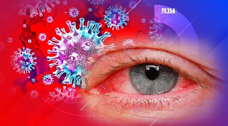 เช็คด่วน! อาการตาแดงแบบไหน ถึงเป็นโควิด-19 เช็คด่วน! อาการตาแดงแบบไหน ถึงเป็นโควิด-19
