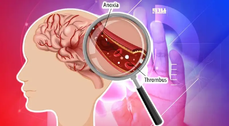 เตือน!โรคหลอดเลือดสมองอันตรายถึงตาย พิการ อาการอย่างไร เช็คที่นี่