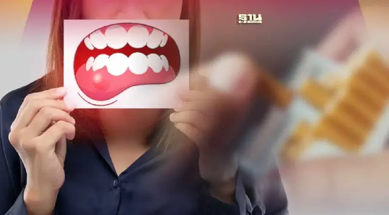 เตือน!การสูบบุหรี่ต้นเหตุมะเร็งช่องปาก ดูด 20 มวนเสี่ยงเพิ่ม 10 เท่า