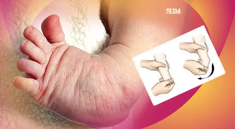 โรคเท้าปุกคืออะไร อาการเป็นยังไง รักษาได้ไหม เช็คเลยที่นี่
