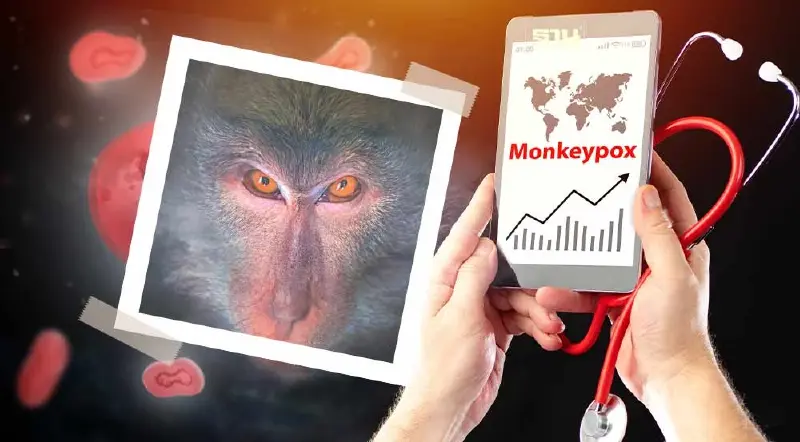 "ฝีดาษวานร" ป้องกันได้ยังไง อาการแบบไหน เช็คเลยที่นี่