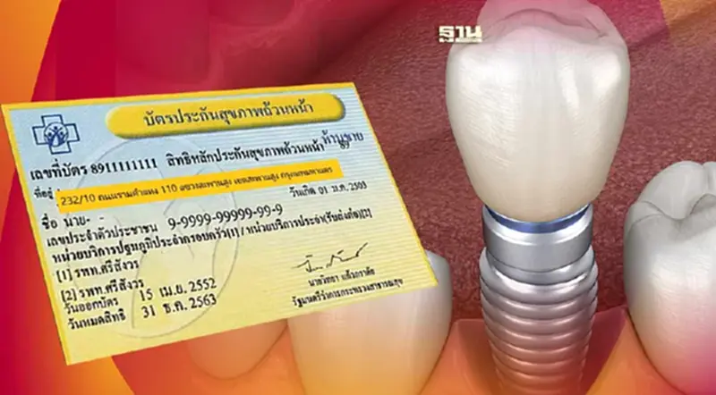 สิทธิบัตรทอง รับบริการใส่ "ฟันเทียม-รากฟันเทียม" ฟรี คลิกเลย สิทธิบัตรทอง รับบริการใส่ "ฟันเทียม-รากฟันเทียม" ฟรี คลิกเลย