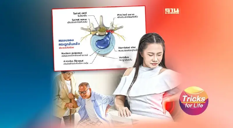 “โรคหมอนรองกระดูก” ชะลอความเสื่อม เลี่ยงผ่าตัด