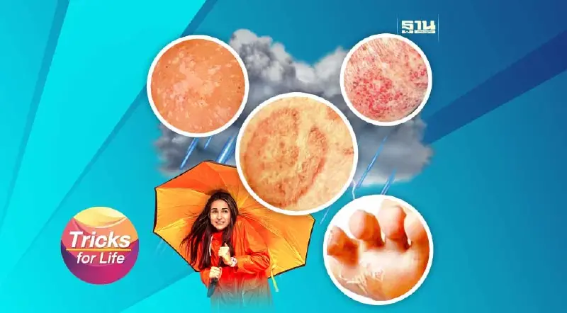 6 โรคผิวหนัง ที่มากับ “หน้าฝน”