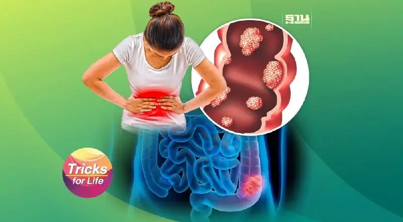 รู้ทัน ลดเสี่ยง “โรคมะเร็งลำไส้”