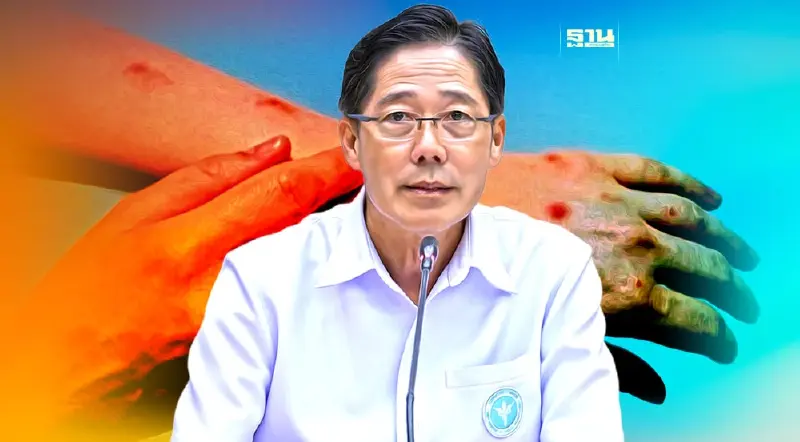 ผงะ!พบผู้ป่วย "ฝีดาษวานร" พุ่งกว่า 2 เท่าใน 1 เดือน