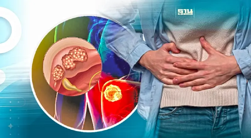 เปิดสาเหตุ มะเร็งตับ-ท่อน้ำดี คร่าชีวิตคนไทยมากที่สุดของมะเร็งทั้งหมด