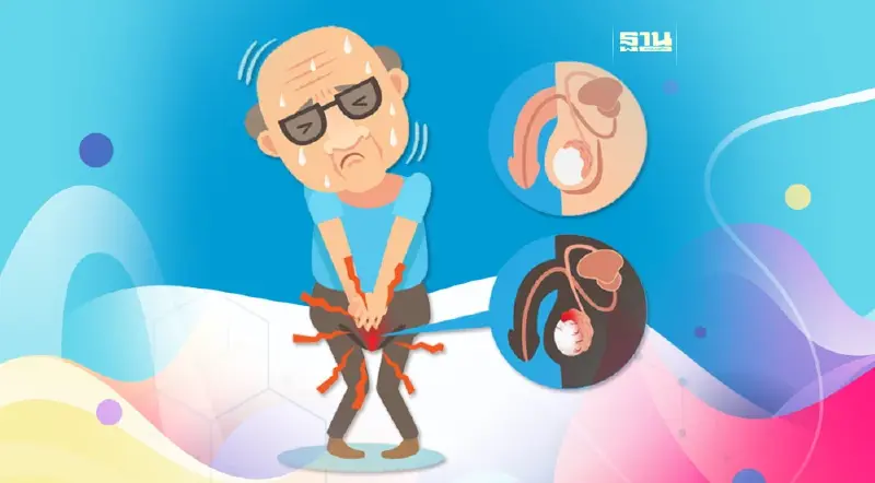 เปิดปัจจัยเสี่ยง "มะเร็งต่อมลูกหมาก" ภัยร้ายเพศชายที่ไม่ควรมองข้าม