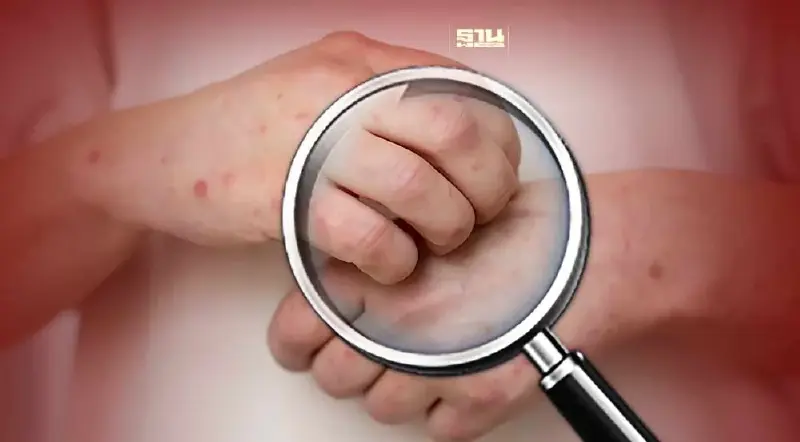 เปิดอาการโรคอีสุกอีใส-ภาวะแทรกซ้อน-วิธีการรักษา พบมากกลุ่ม5-12 ปี