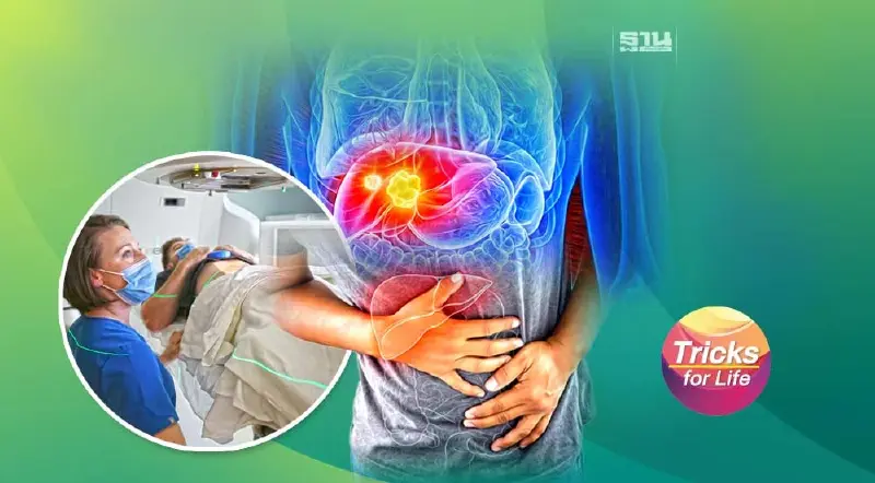 “โรคมะเร็งตับ” กับการรักษาทางเลือก