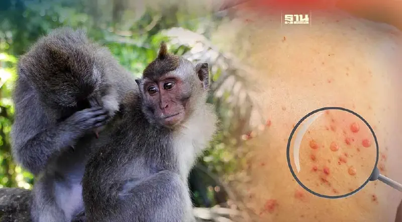 "โรคฝีดาษลิง" เช็คอาการ กลุ่มเสี่ยงพร้อมวิธีป้องกันโรค