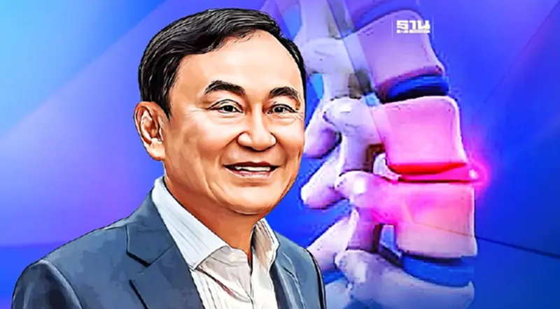 รู้จัก"โรคกระดูกเสื่อมกดทับเส้นประสาท" โรคประจำตัว"ทักษิณ ชินวัตร" รู้จัก"โรคกระดูกเสื่อมกดทับเส้นประสาท" โรคประจำตัว"ทักษิณ ชินวัตร"