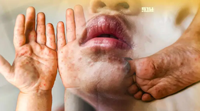 "โรคมือ เท้า ปาก"เกิดจากอะไร อาการยังไง ป้องกันแบบไหน เช็คเลยที่นี่