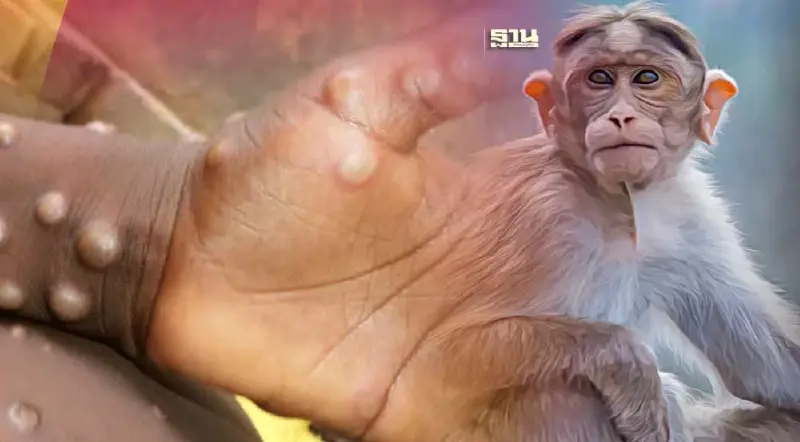 กทม.เฝ้าระวังโรคฝีดาษลิง หลังยอดติดเชื้อพุ่ง