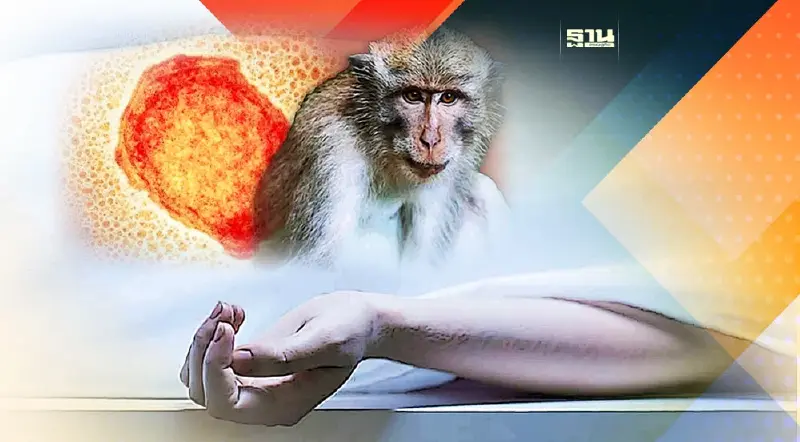 พบผู้ติดเชื้อ HIV ป่วย "ฝีดาษลิง" เสียชีวิตรายแรกในไทย