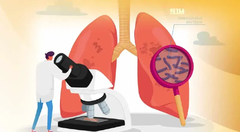 เปิด 10 กลุ่มเสี่ยงติดเชื้อ"วัณโรค"หลังไทยติด1 ใน30 ของโลกที่มีปัญหา