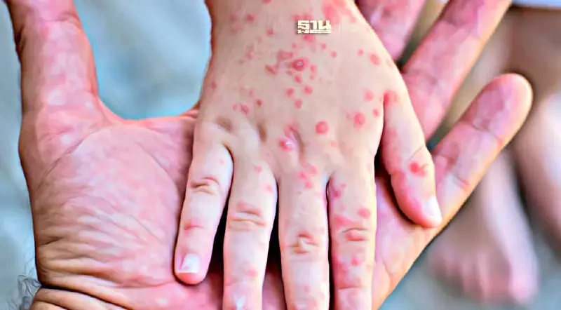 เช็ค 6 อาการเฝ้าระวังป่วยเป็น "โรคฝีดาษลิง"   