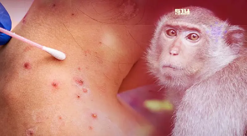 เปิดสาเหตุ "โรคฝีดาษลิง" หากระบาดแล้วยากจะควบคุม