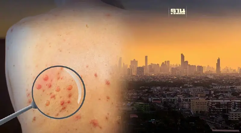 กทม.เข้ม เฝ้าระวังโรคฝีดาษลิง หลังพบตัวเลขผู้ติดเชื้อเพิ่ม