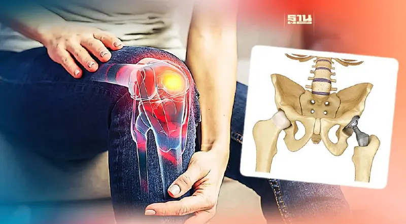 ผู้มีรายได้น้อย ผ่าตัดเปลี่ยนข้อเข่า-ข้อสะโพกเทียม 200 ข้อ ฟรี!