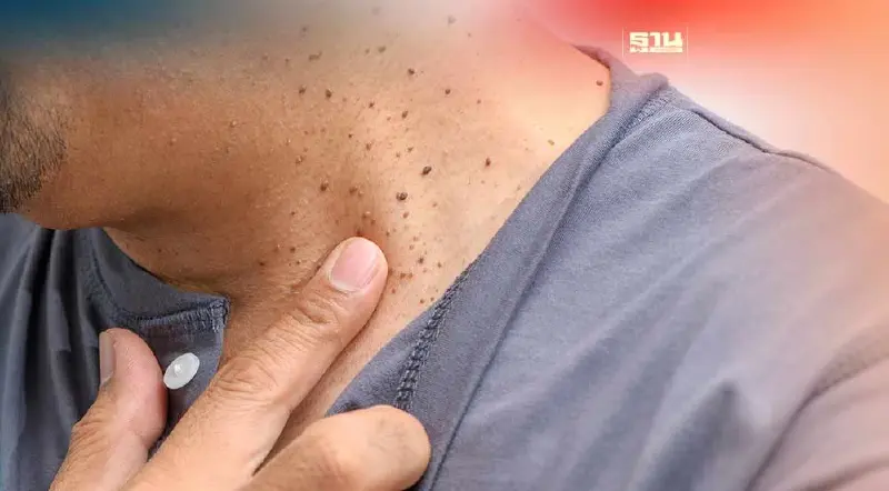 "ติ่งเนื้อที่คอ" อาการ-สาเหตุ เช็กวิธีรักษาแบบพื้นบ้าน-ทางการแพทย์