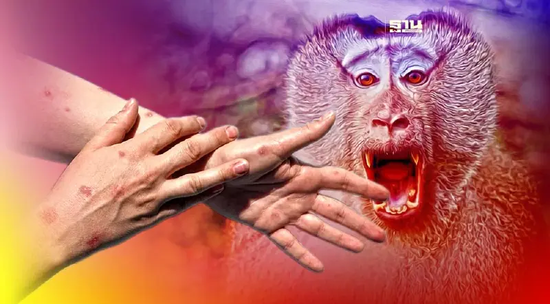 ผงะ!ติดเชื้อ"ฝีดาษลิง"ในไทยสูงกว่าเอเชีย-โลกกว่า 10 เท่า