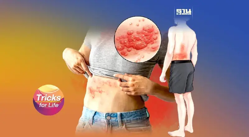 เป็น ‘งูสวัด’ ทำไมเสี่ยงตาบอด