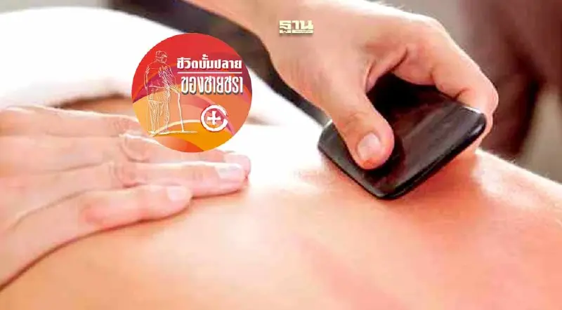 การรักษาโรคด้วยวิธีการ “กัวซา”