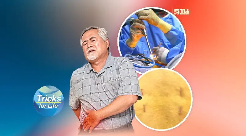 Full Endo TLIF แก้ตรงจุด ลดปวดหลัง Full Endo TLIF แก้ตรงจุด ลดปวดหลัง