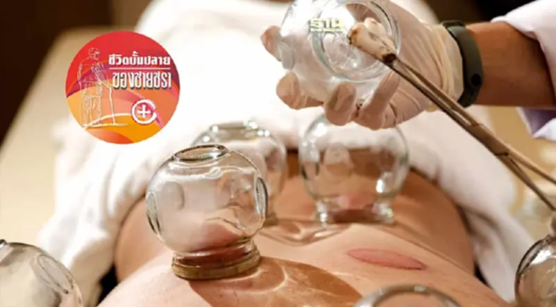 การรักษาด้วยวิธีครอบแก้วของแพทย์แผนจีน การรักษาด้วยวิธีครอบแก้วของแพทย์แผนจีน