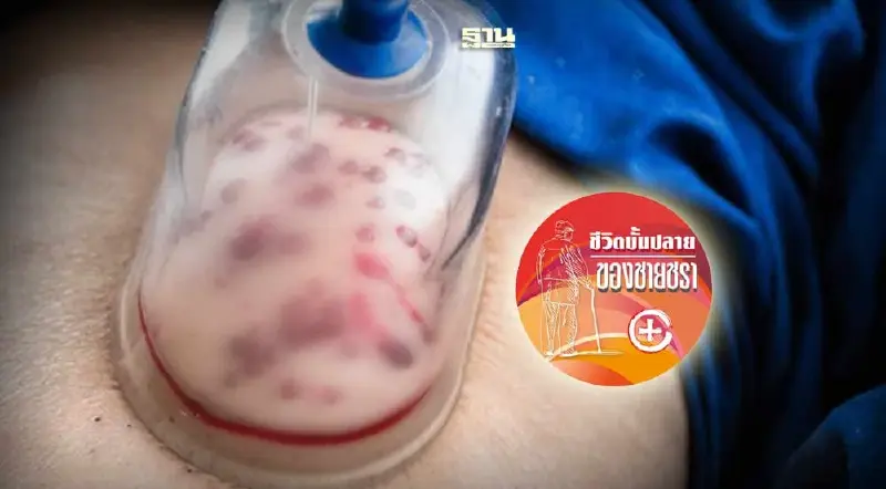 การรักษาทางแพทย์แผนจีนด้วยการถ่ายเลือด