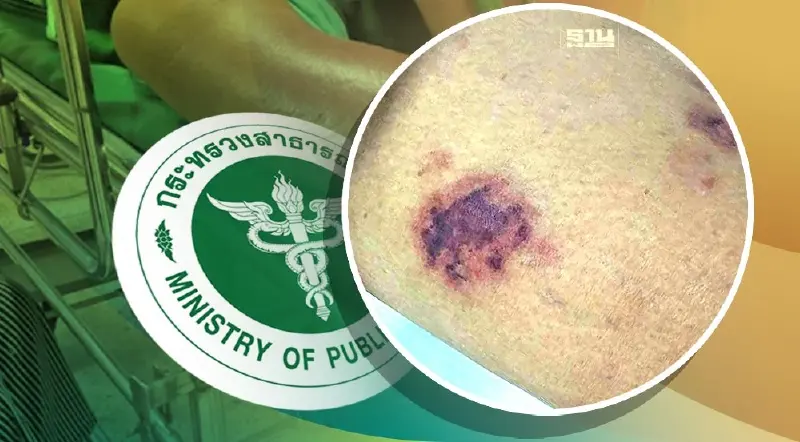 กรมควบคุมโรค แจงข้อเท็จจริง โรคแบคทีเรียกินเนื้อ กรมควบคุมโรค แจงข้อเท็จจริง โรคแบคทีเรียกินเนื้อ