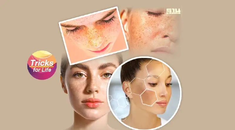 ฝ้า กระ ปัญหาผิว เรื่องใกล้ตัว ที่ต้องรู้!