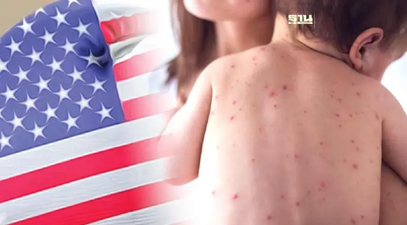 CDC เตือนแนวโน้ม “โรคหัด” ระบาดในสหรัฐพุ่งแซงปี 66 WHO ย้ำความสำคัญของวัคซีน