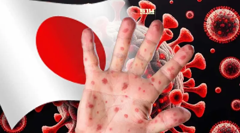 ระวัง "โรคหัด" กำลังระบาด กงสุลใหญ่ในโอซากา เตือนคนไทยไปญี่ปุ่น